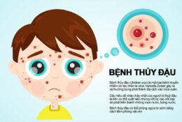 THỦY ĐẬU – BỆNH THƯỜNG GẶP VÀO MÙA XUÂN